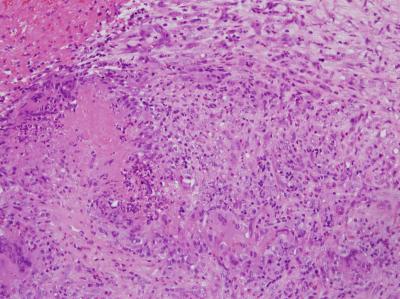 Figure 1: TURP sample showed granulomatous inflammation accompanied by central necrosis